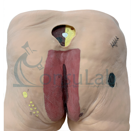 Modelo de Úlcera por Pressão